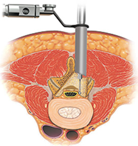 Minimally Invasive Laminectomy Surgery