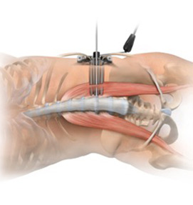Extreme Lateral Interbody Fusion (XLIF) Back Surgery