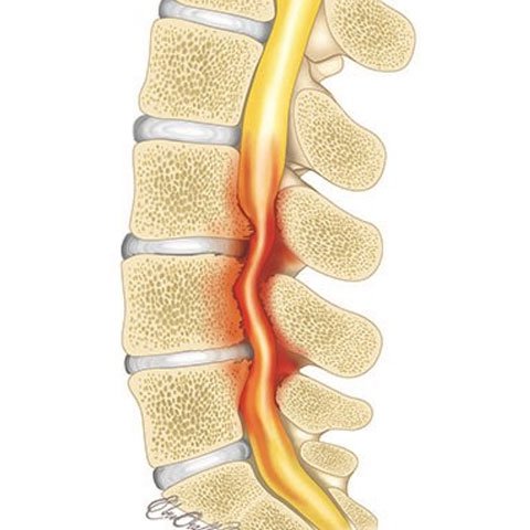 Spinal Stenosis Pain
