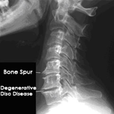 Bone Spur in Spine and Spinal Arthritis