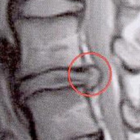 Bulging Disc
