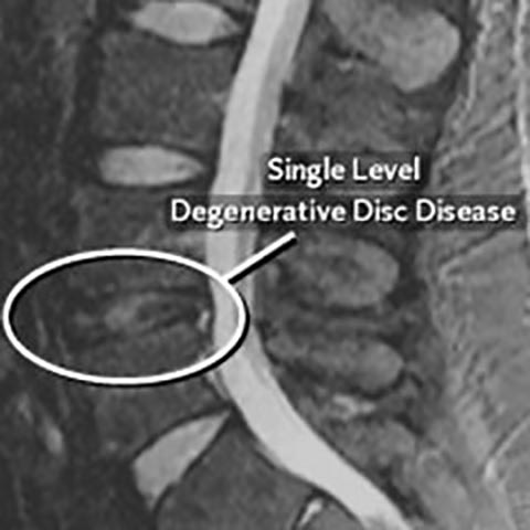Degenerative Disc