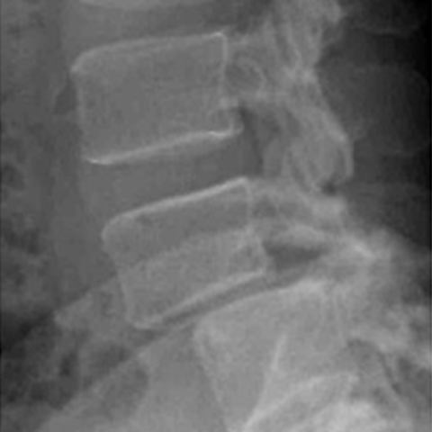 Facets Arthritis