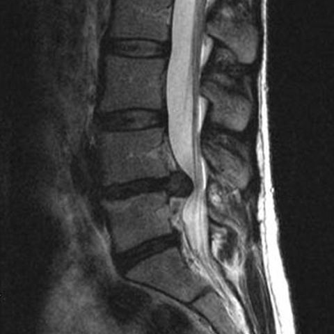 Herniated Disc