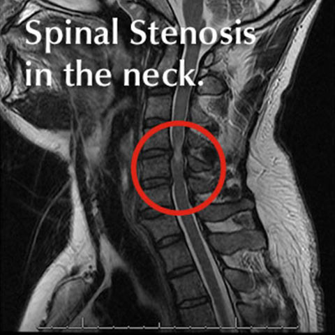 Myelopathy