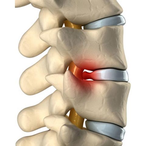Pinched Nerve Pain
