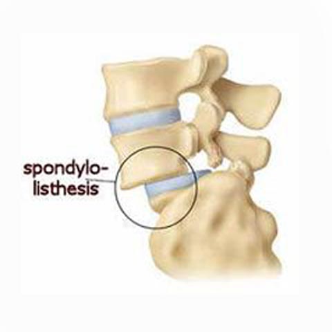 Spondylolisthesis Condition