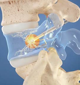 Intracept Prodcedure
