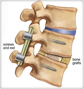 Anterior Lumbar Interbody Fusion (ALIF)