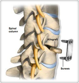 Anterior cervical discectomy and fusion (ACDF)