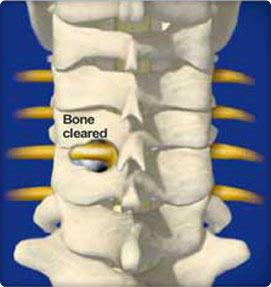 Cervical Foraminotomy Procedure