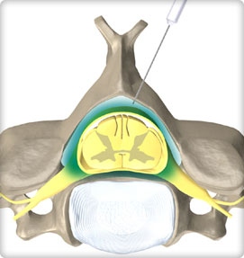 Epidural Steroid Injection Procedure