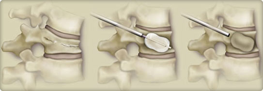 Kyphoplasty and Vertebroplasty