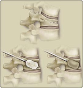 Kyphoplasty and Vertobroplasty Procedure