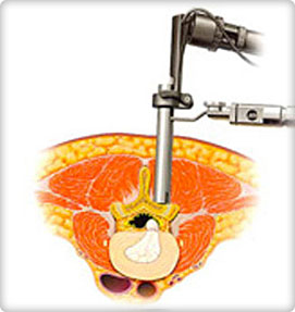 Discectomy Procedure