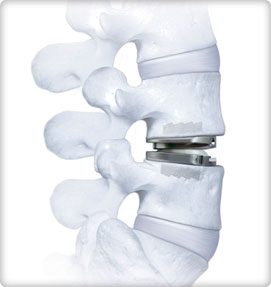 Cervical Disc Replacement Graphic