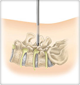Minimally Invasive Spine Surgery