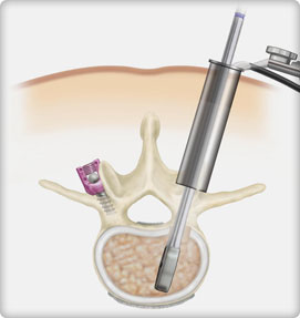 Minimally Invasive Fusion Surgery