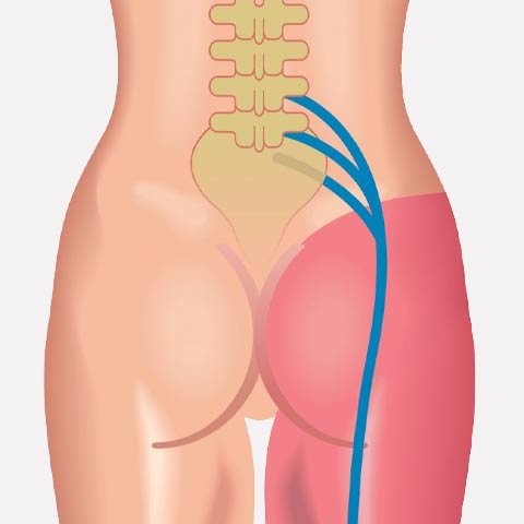 Sciatica Pain