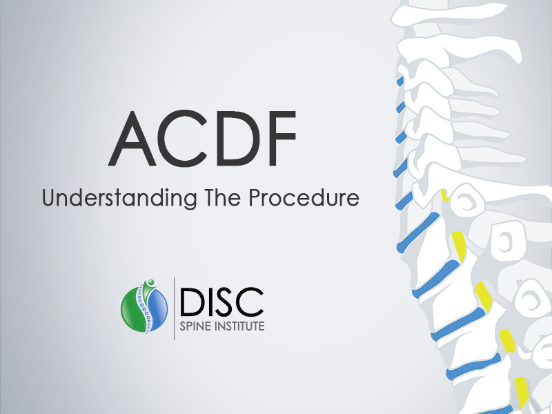 ACDF Surgery: Six Things You Should Know