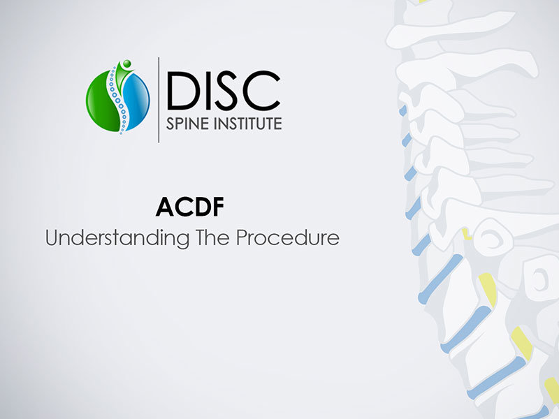 Anterior Cervical Discectomy & Fusion (ACDF)