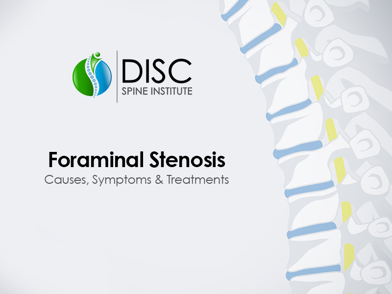 Foraminal Stenosis