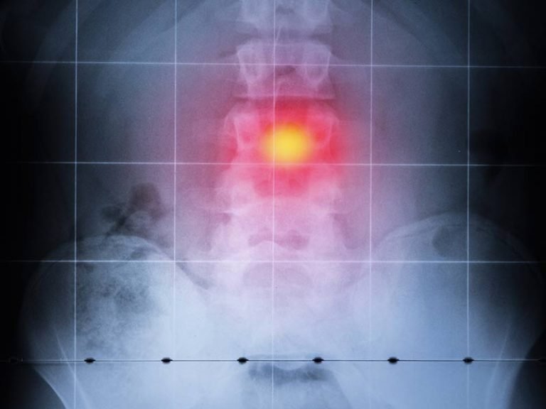 compression fracture X-ray