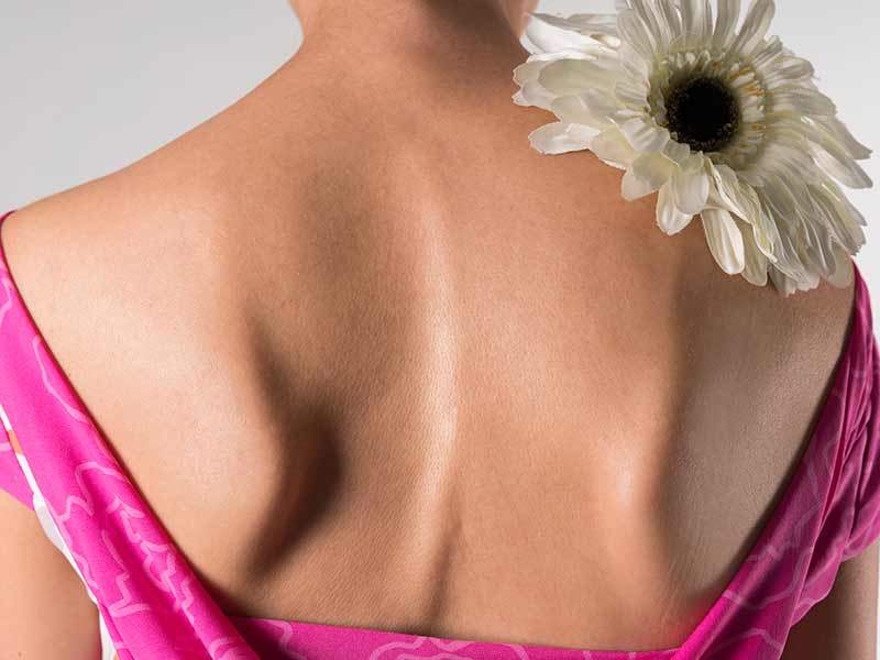 is scoliosis hereditary, woman's back