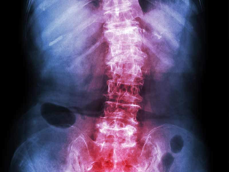 there are scoliosis treatments