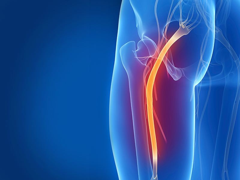 Sciatica treatment