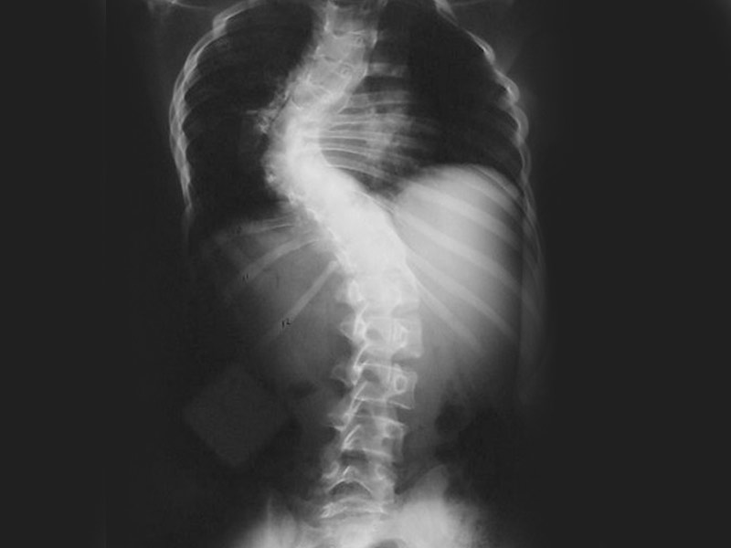 Scoliosis treatment