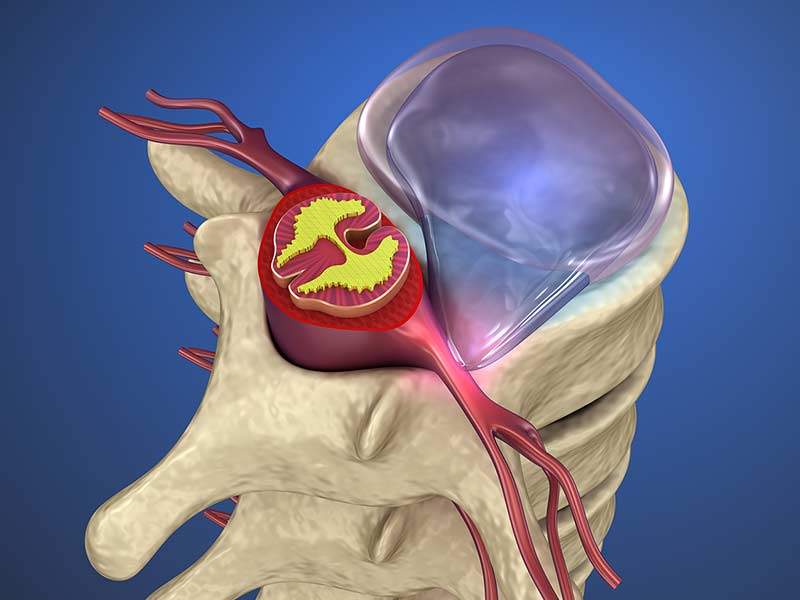 Diagram of a herniated disc