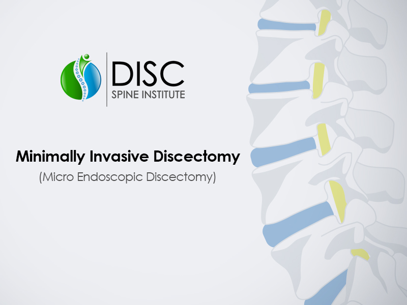 Minimally Invasive Discectomy