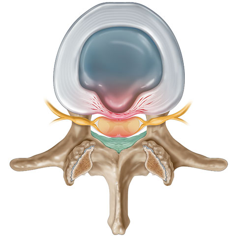 Bulging Disc Image