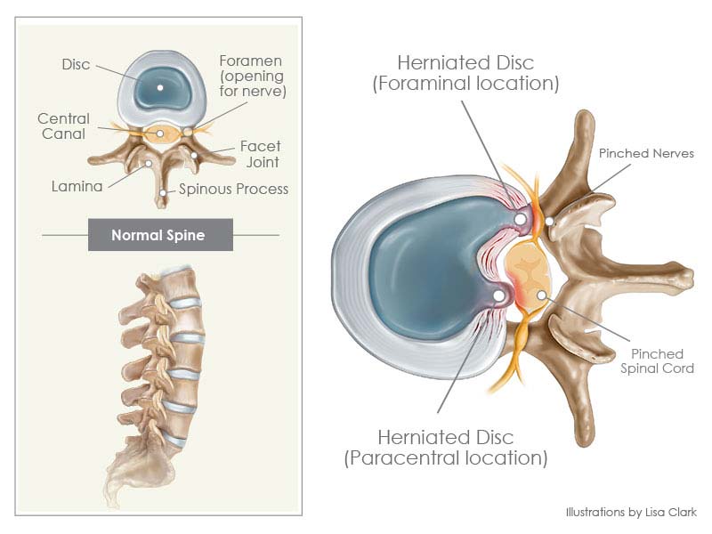 Herniated Disc