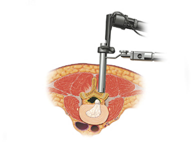 minimally invasive discectomy surgery diagram