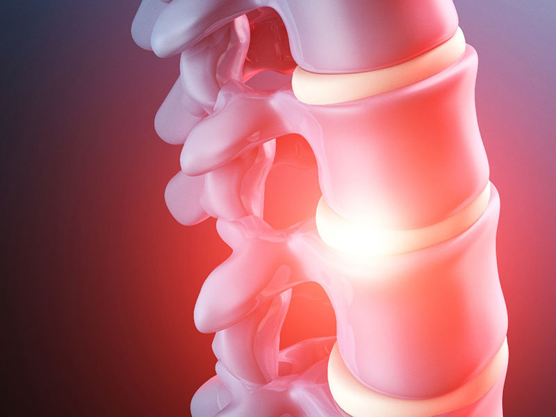 herniated disc image